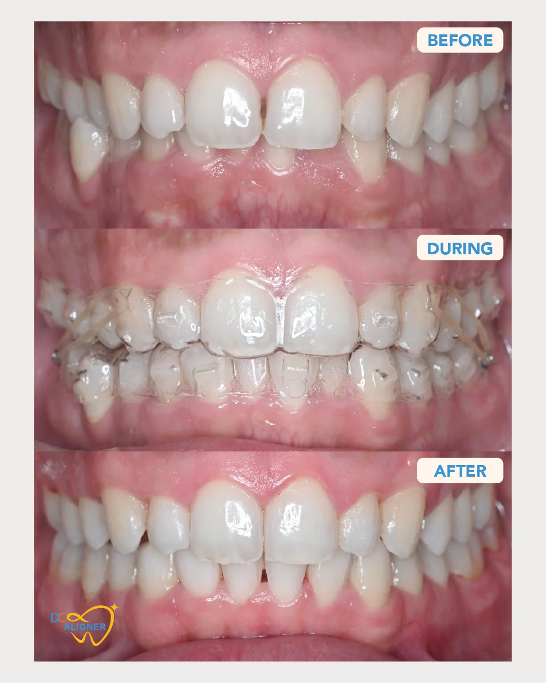 รีวิวจัดฟันใส DC Aligner 1 มุมหน้าตรง