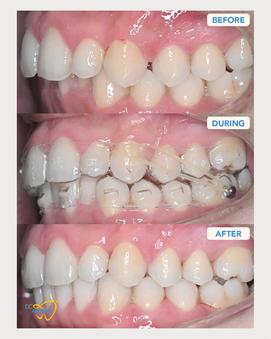 รีวิวจัดฟันใส DC Aligner 1 มุมด้านซ้าย