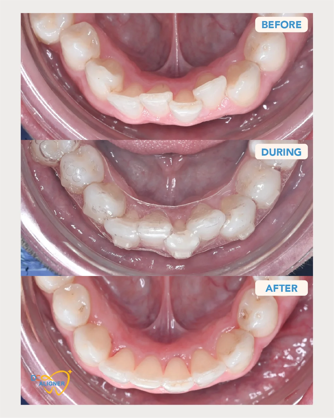 รีวิวจัดฟันใส DC Aligner 1 มุมขากรรไกรล่าง