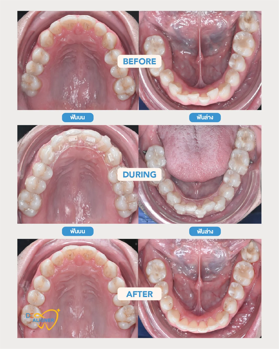 รีวิวจัดฟันใส DC Aligner 1 มุมสบฟัน