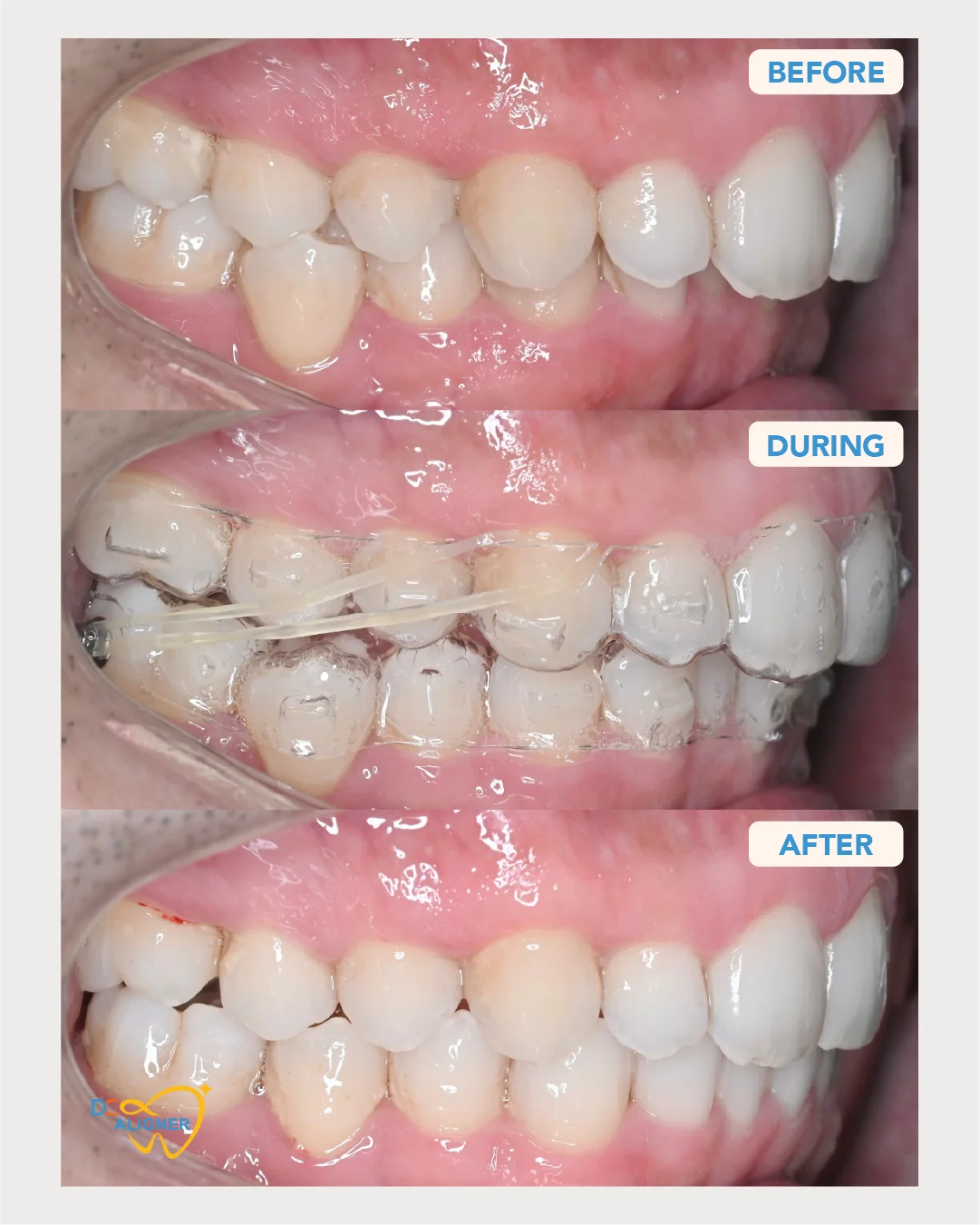 รีวิวจัดฟันใส DC Aligner 1 มุมด้านขวา