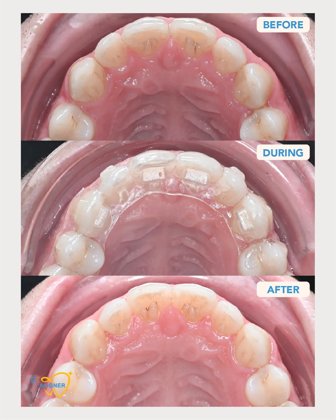 รีวิวจัดฟันใส DC Aligner 1 มุมขากรรไกรบน