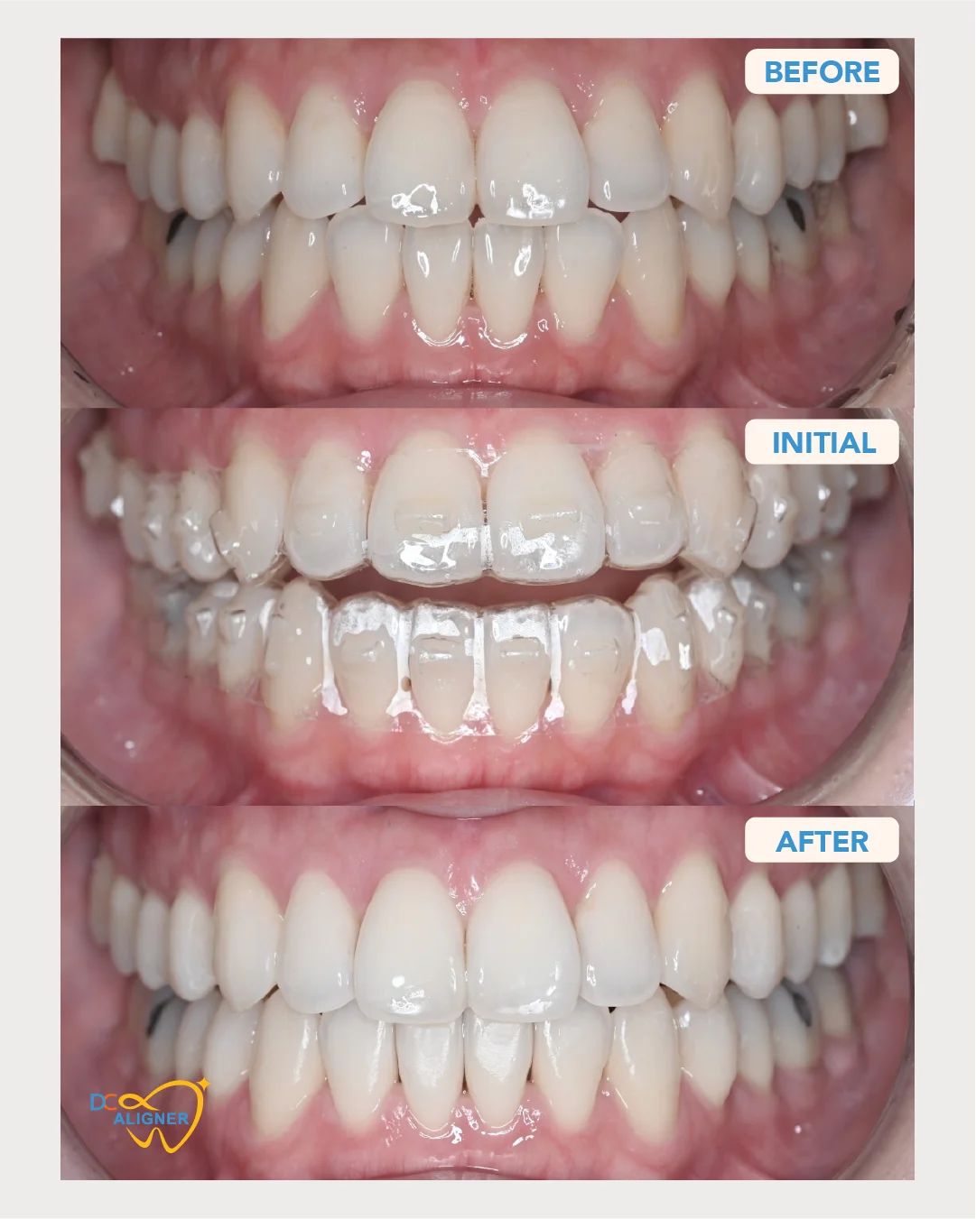 รีวิวจัดฟันใส DC Aligner 2 มุมหน้าตรง