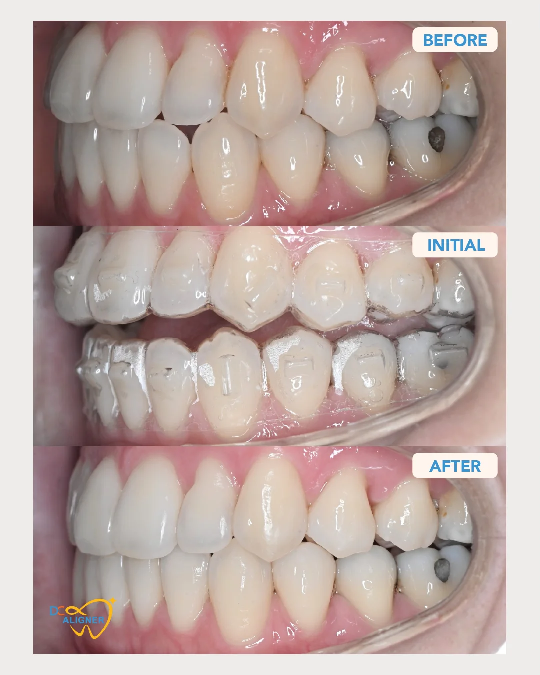 รีวิวจัดฟันใส DC Aligner 2 มุมด้านซ้าย