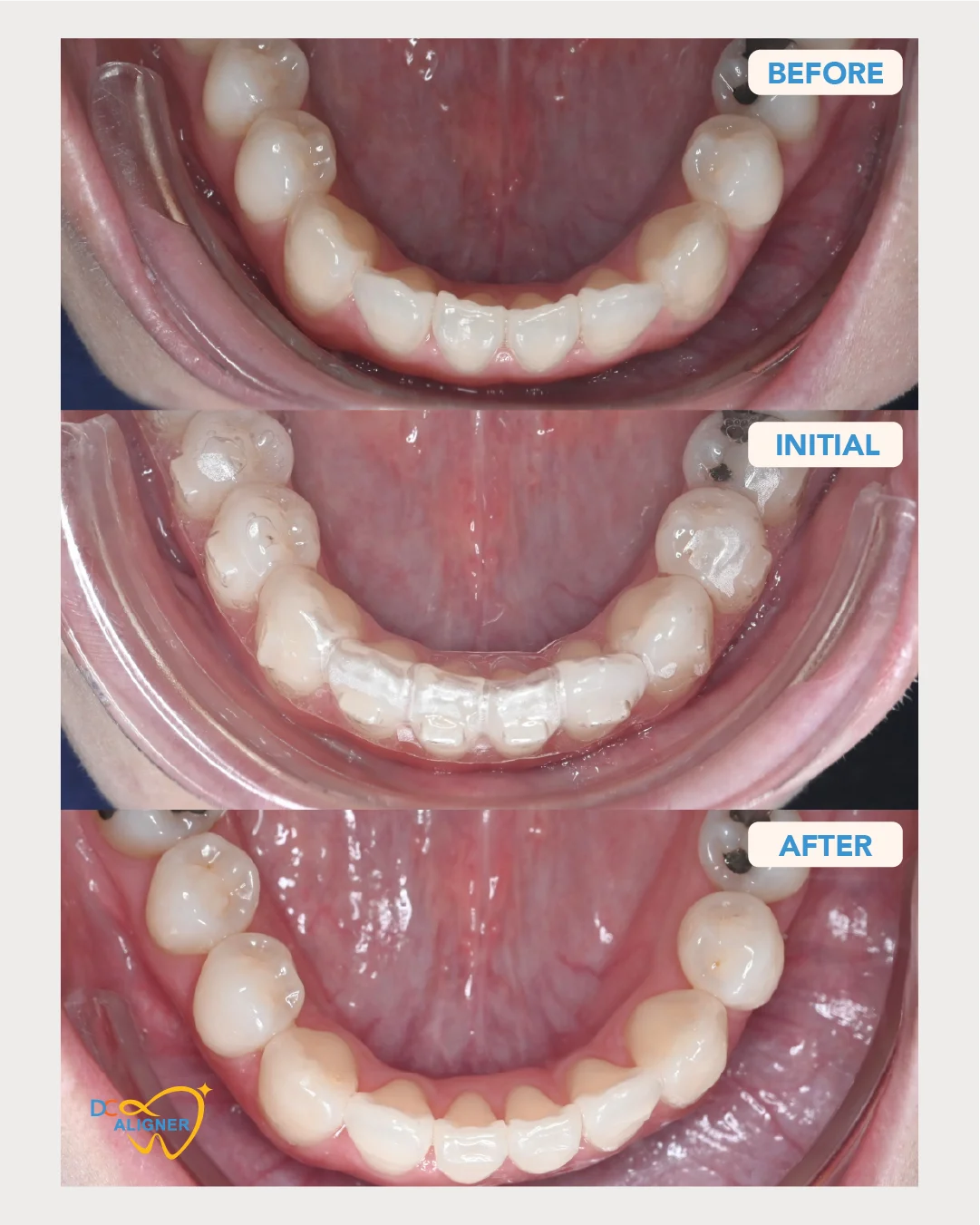 รีวิวจัดฟันใส DC Aligner 2 มุมขากรรไกรล่าง