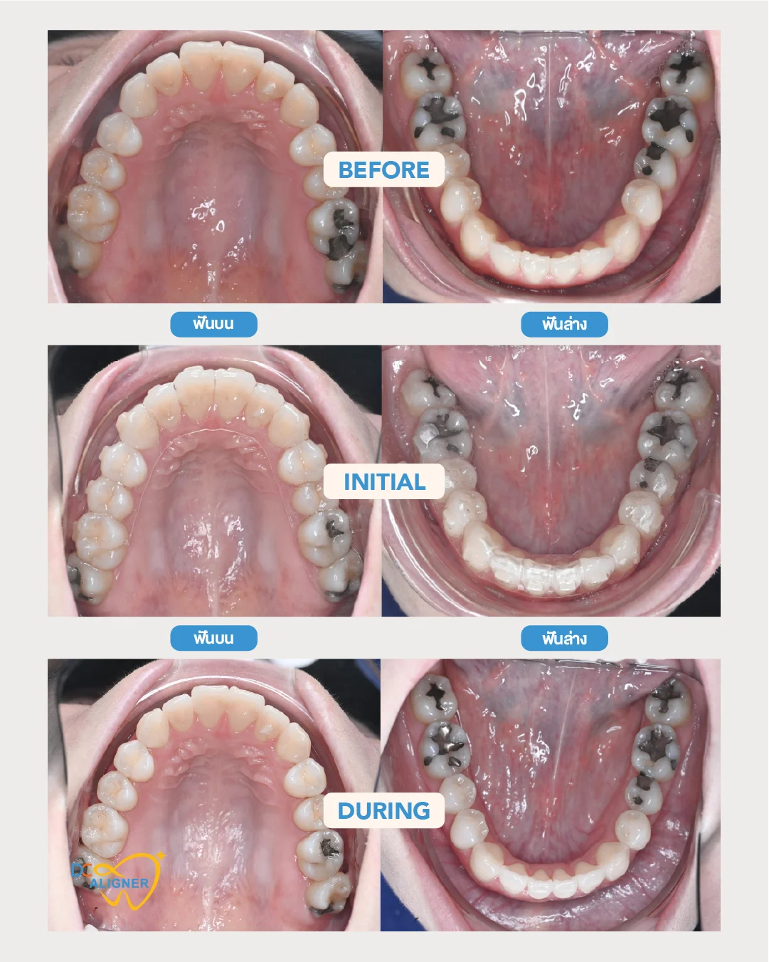 รีวิวจัดฟันใส DC Aligner 2 มุมสบฟัน