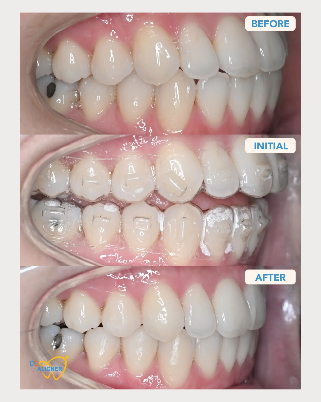 รีวิวจัดฟันใส DC Aligner 2 มุมด้านขวา