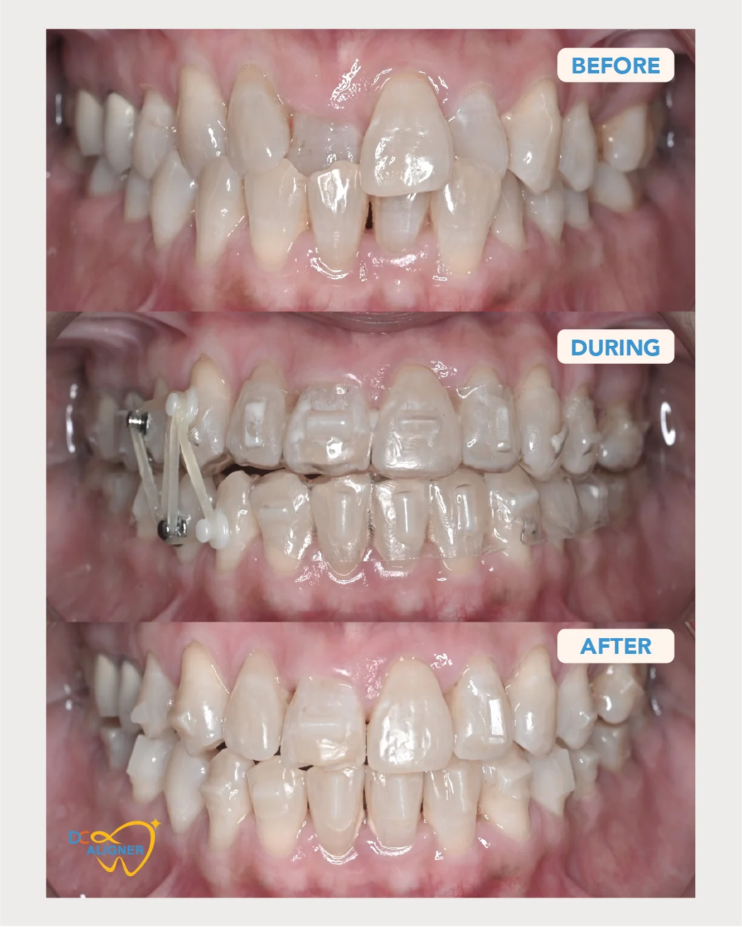 รีวิวจัดฟันใส DC Aligner 3 มุมหน้าตรง