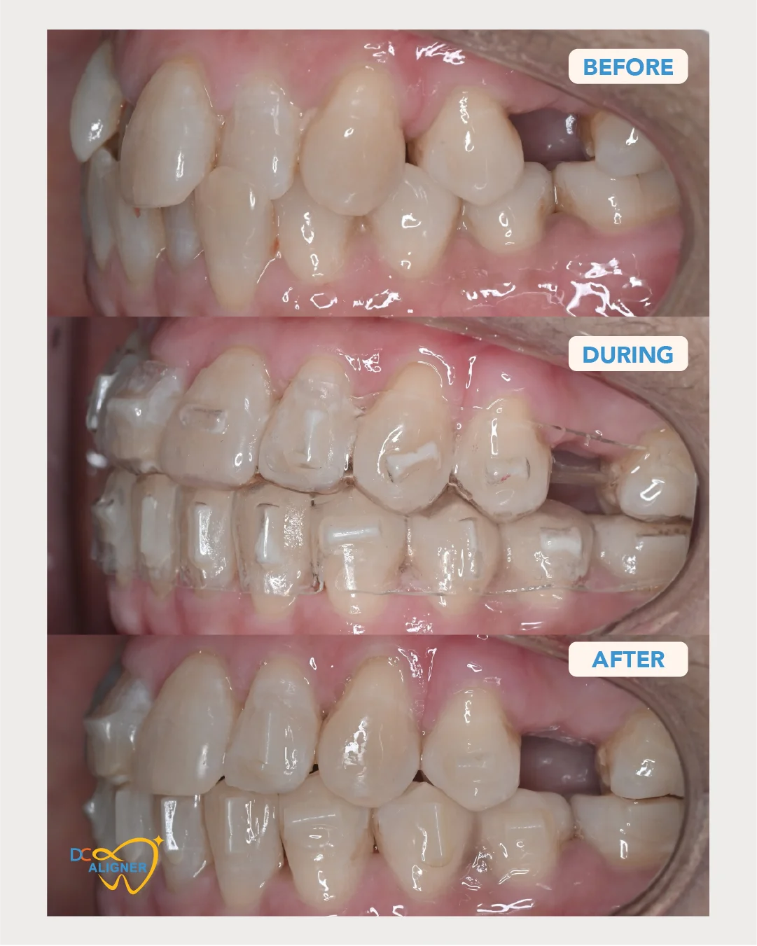 รีวิวจัดฟันใส DC Aligner 3 มุมด้านซ้าย