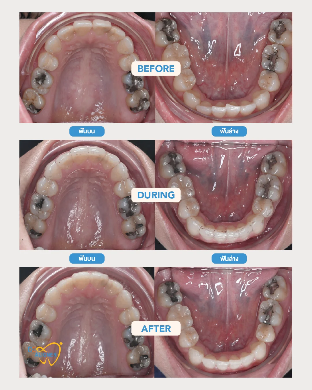 รีวิวจัดฟันใส DC Aligner 3 มุมสบฟัน